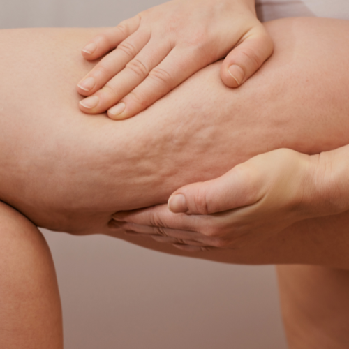 Cellulit usuwanie biala podlaska