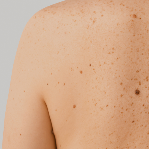 znamiona usuwanie biala podlaska